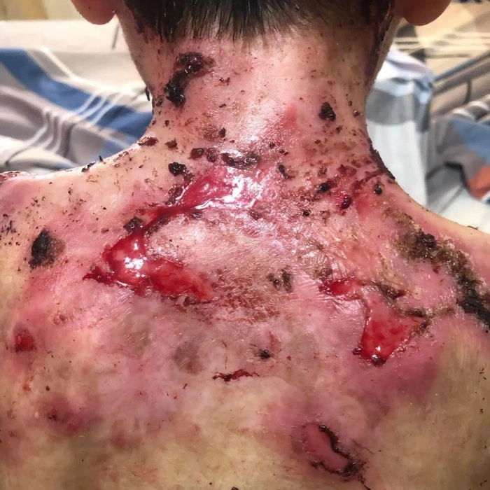 Epidermólisis Bullosa en detalle.